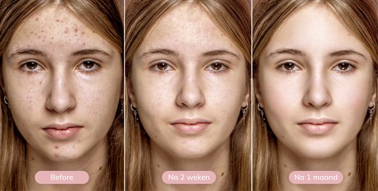 Vimora Élimination des points noirs - Nettoyant visage - Élimination des boutons - Nettoyant visage - Soins hommes et femmes - Acné et boutons - Set de soins du visage - Nettoyant pur